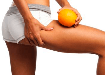 odstranění celulitidy