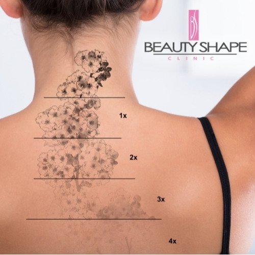 laserové odstranění tetování v Praze