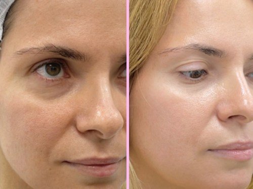 Laserový peeling s karbonovou maskou