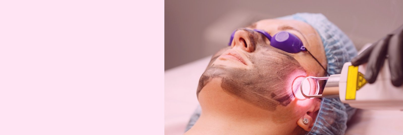 karbonový laserový peeling