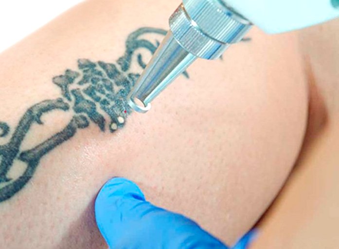 Laser tattoo removal in Prague Laser tattoo removal